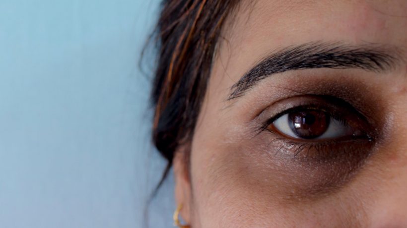 How to remove laser dark circles