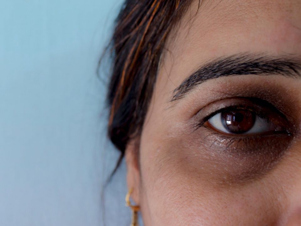 How to remove laser dark circles