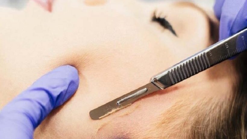 Why Dermaplaning Is All the Rage